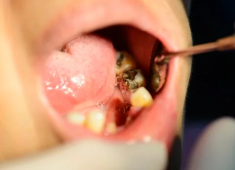 Close up shot of dentist checking a broken teeth Stock Photos