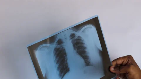 Close shot of a hand holding x-ray report of chest Stock Footage 147098673