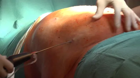 Close up shot of Liposuction And Belly Fat being taken out in the hospital Stock Footage 239580112