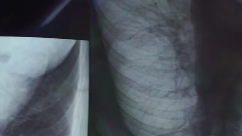 Close-up shot of lungs on screen Stock Footage 139688103