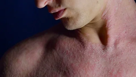 Close-up shot of a man with psoriasis, rush on a body skin, chronic skin disease Vidéo 95048920