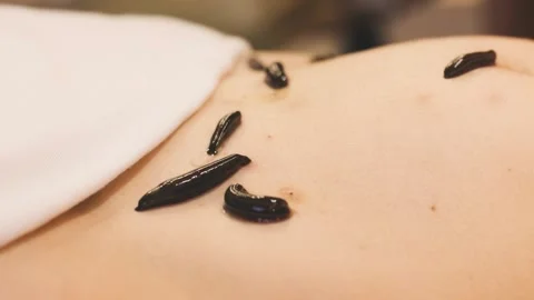 Close-up shot of medical leech on human body skin drinking blood traditional Stock Footage 311985671