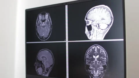 Close shot of an MRI scan on a human brain on a monitor Stock Footage 316684840
