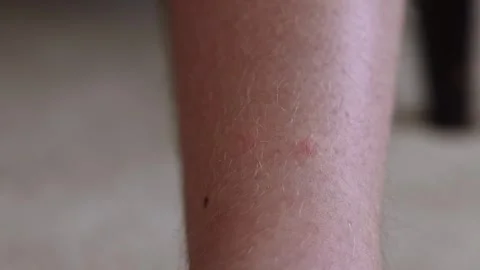 Close-up shot of red marks left on a person leg after ticks being removed Stock Footage 310768275