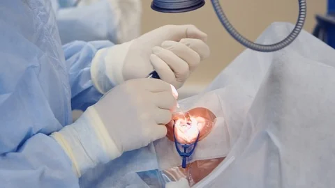 Close up shot of a surgeon's hands, he performs an operation to restore vision Stock Footage 90926009