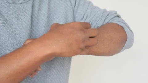 Close up shot of young man scratching his hand due to itching or allergy on.. Vídeos de archivo 332746529