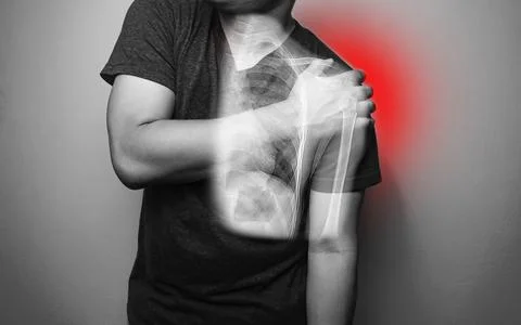 Close up Shoulder and humerus bone fracture pain in a man, Young man holding  Stock Photos