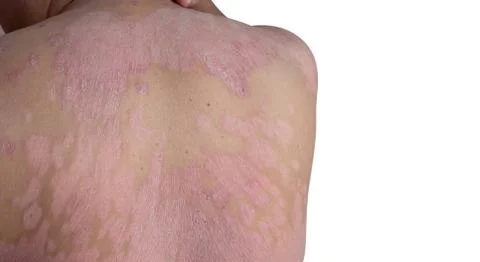 Close up the shoulder ulcers and back Foto stock