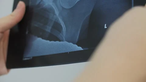 Close-Up of Shoulder X-Ray Examination Stock Footage 304742260