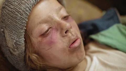 Close Up Sick Child Coughing With Bruised Dirty Face And Beanie Video stock 329463982