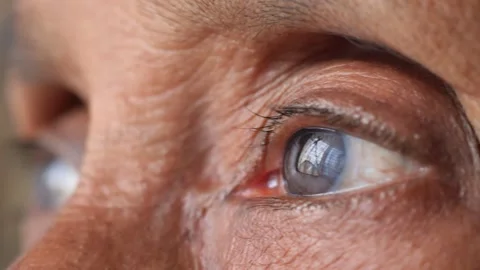 Close up side view of aging eye showing cloudy pupil and wrinkled skin textur Stock Footage 332473106
