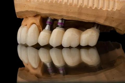 Close-up side view of a dental upper jaw prosthesis on black glass background Stock Photos
