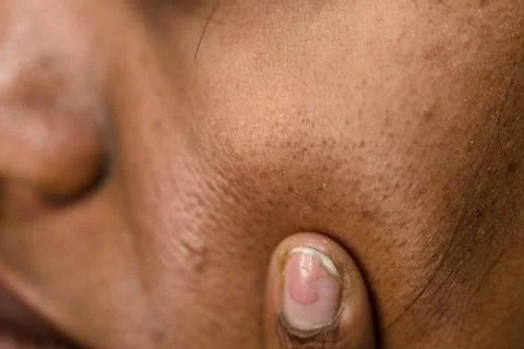 Close up of skin texture with finger touching cheek Stock Photos