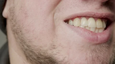 Close-up smile of a broken tooth with cavities and dental problems. Stone on the Vidéo 231136759