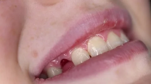 Close-up of the smile of a child who is missing a tooth Stock Footage 305873963