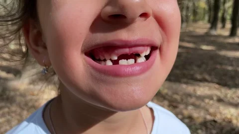 Close up of a smiling child showing missing teeth in a sunny outdoor setting Stock Footage 303144340