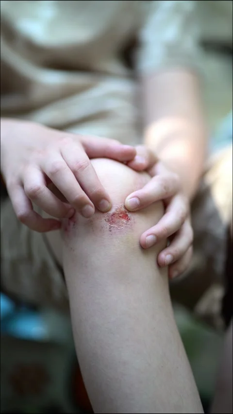Close-up of sore and scraped wound on child's knee.  Stock Footage 342191483