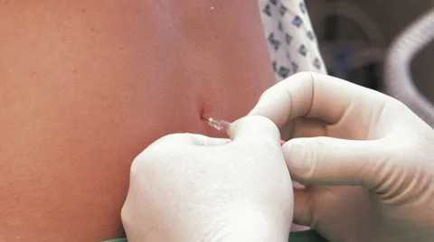 Close up spinal anesthesia Stock Footage 67280681