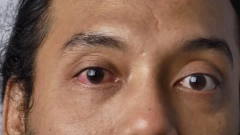 Close-up static video eye irritation due to bacteria. Vidéo 317496177