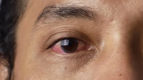 Close-up static video eye irritation due to bacteria. Vídeos de archivo 317496408