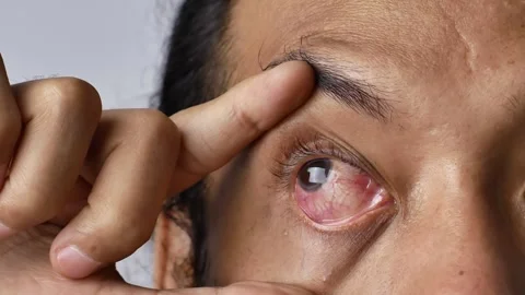 Close-up static video eye irritation due to bacteria. Vídeos de archivo 317496598