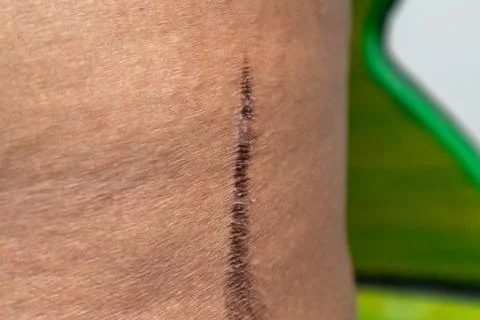 Close up stretch Marks and dead skin of fat man Stock Photos