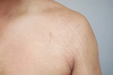 Close-Up of Stretch Marks on Human Skin for Medical and Cosmetic Purposes Stock Photos