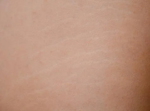 Close-up of stretch marks on the thigh and the texture of human skin. Stock Photos