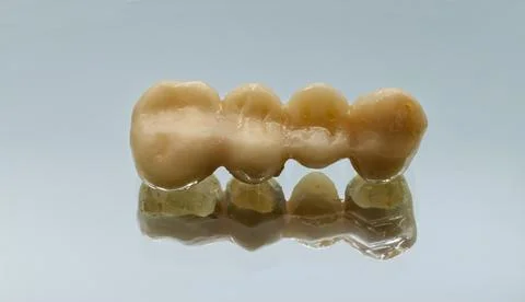 A close-up studio shot captures a three-unit dental bridge restoration Stock Photos