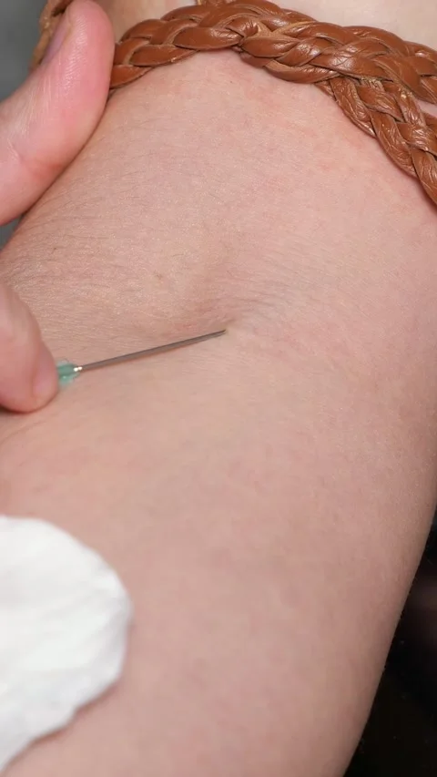 Close up of subcutaneous injection into a patient's arm for vitamin therapy Stock Footage 342944948