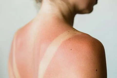 Close-up of a sunburn marks on a woman's back Stock Photos
