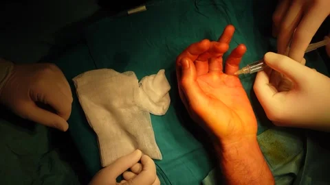 Close Up of Surgeon Administering Local Anesthesia into Patient Hand Stock Footage 329611935