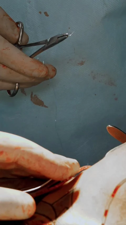 Close-up. surgeon and his assistant suture the incisions under the mammary Stock Footage 314455243