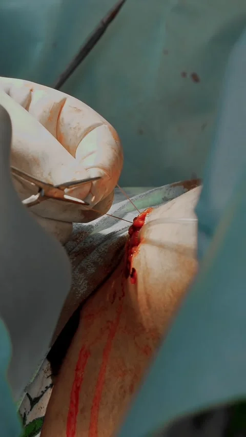 Close-up. surgeon and his assistant suture the incisions under the mammary Stock Footage 318725826