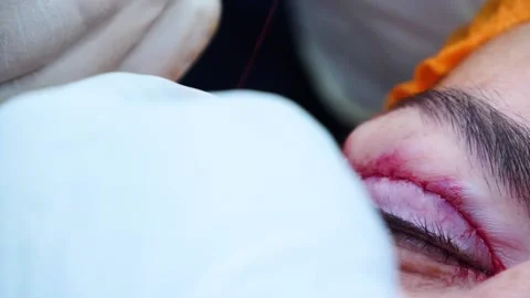 Close-up of a surgeon cuts the surgical thread and sutures the patient's eyelids Stock Footage 145602971