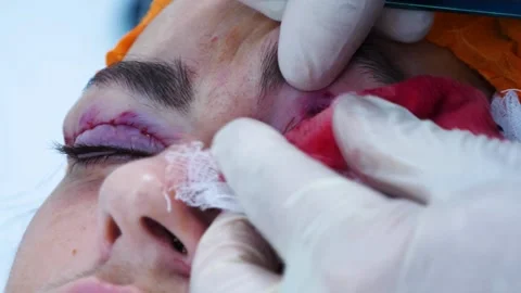 Close up of surgeon do plastic surgery. A surgeon removing piece of skin from Stock Footage 145601894