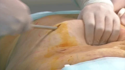 Close-up Of Surgeon Hands Drawing Correction Lines On Woman Stomach Stock Footage 83191637