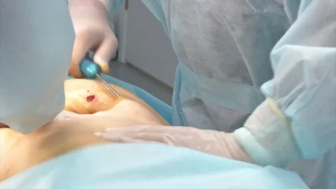 Close-up Of Surgeon Hands Drawing Correction Lines On Woman Stomach Stock Footage 83200742