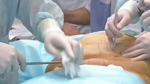 Close-up Of Surgeon Hands Drawing Correction Lines On Woman Stomach Video stock 83202830