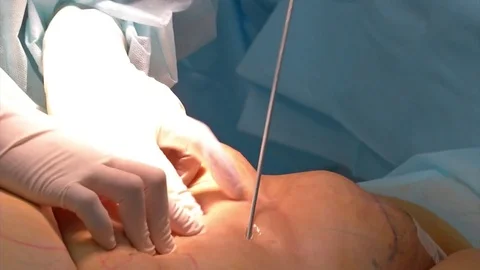 Close-up Of Surgeon Hands Drawing Correction Lines On Woman Stomach Video stock 83202926