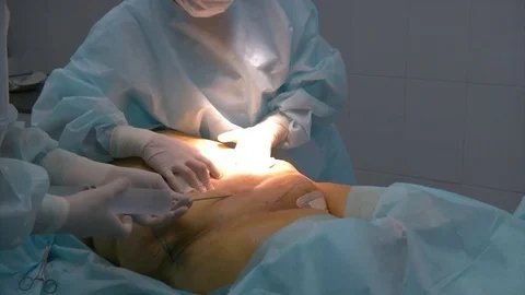 Close-up Of Surgeon Hands Drawing Correction Lines On Woman Stomach Video stock 83202968