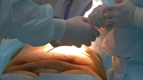 Close-up Of Surgeon Hands Drawing Correction Lines On Woman Stomach Video stock 83203039