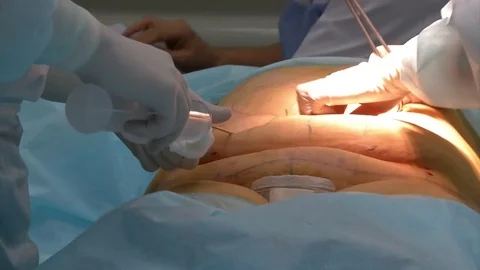Close-up Of Surgeon Hands Drawing Correction Lines On Woman Stomach Video stock 83203118