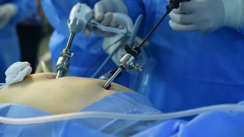 Close-up of surgeon hands performing laparoscopic surgery Video stock 108277003