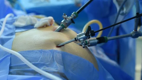 Close-up of surgeon hands performing laparoscopic surgery Video stock 108277148