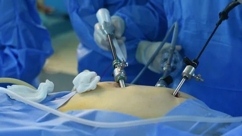 Close-up of surgeon hands performing laparoscopic surgery Video stock 108277162