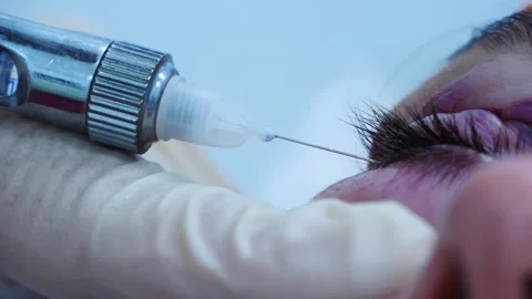 Close up of a surgeon puts an injection in the patient eye. Plastic surgery Stock Footage 145602525