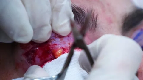 Close up of a surgeon removing piece of fat from eyelid. Plastic surgery Video stock 145602330