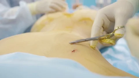 Close-up. The surgeon sews up the wound. Makes a seam on the back Stock Footage 124404373