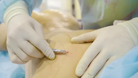 Close-up. The surgeon sews up the wound. Sutures on the back with a surgical Stock Footage 124404415
